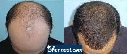 dutasteride for hair loss hindi