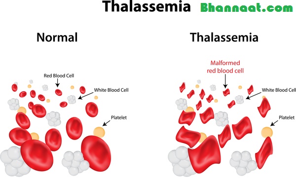 Thalassemia Symptoms and Treatment In Hindi